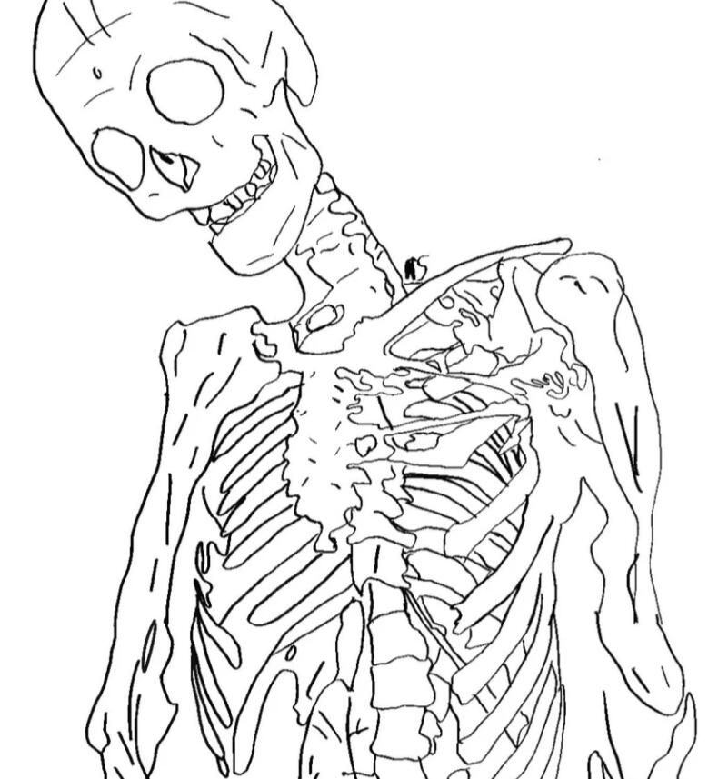 Fibrodysplasia ossificans progressiva Fibrodysplasia ossificans progressiva